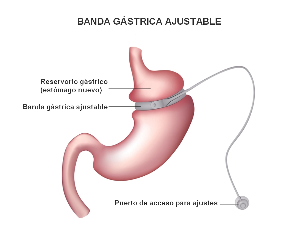 banda gástrica