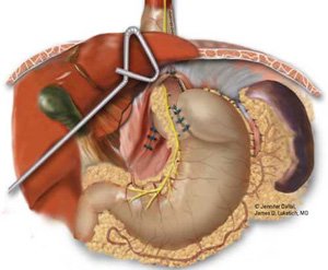 fundoplicatura